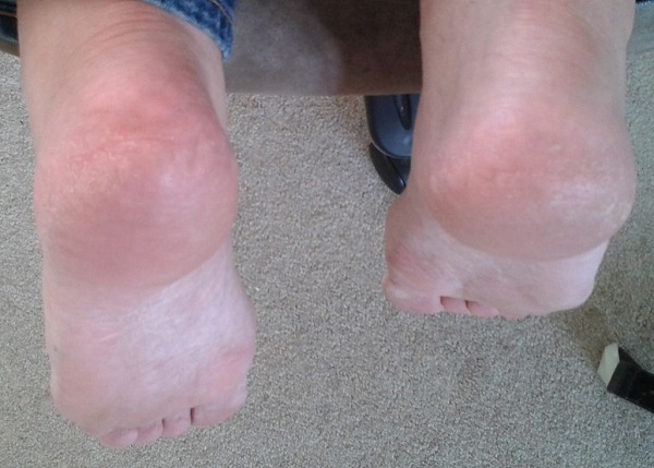 Heels after application of Neostrata Problem Dry Skin Cream